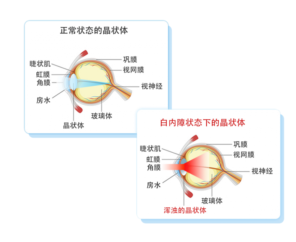 做白内障手术,可以不植入人工晶体吗?
