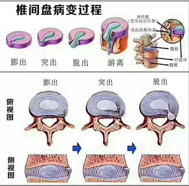 得了腰椎间盘突出症,该怎么办?