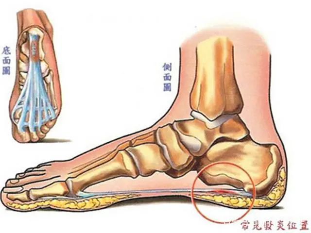 为什么脚跟疼这些招数缓解90足跟痛