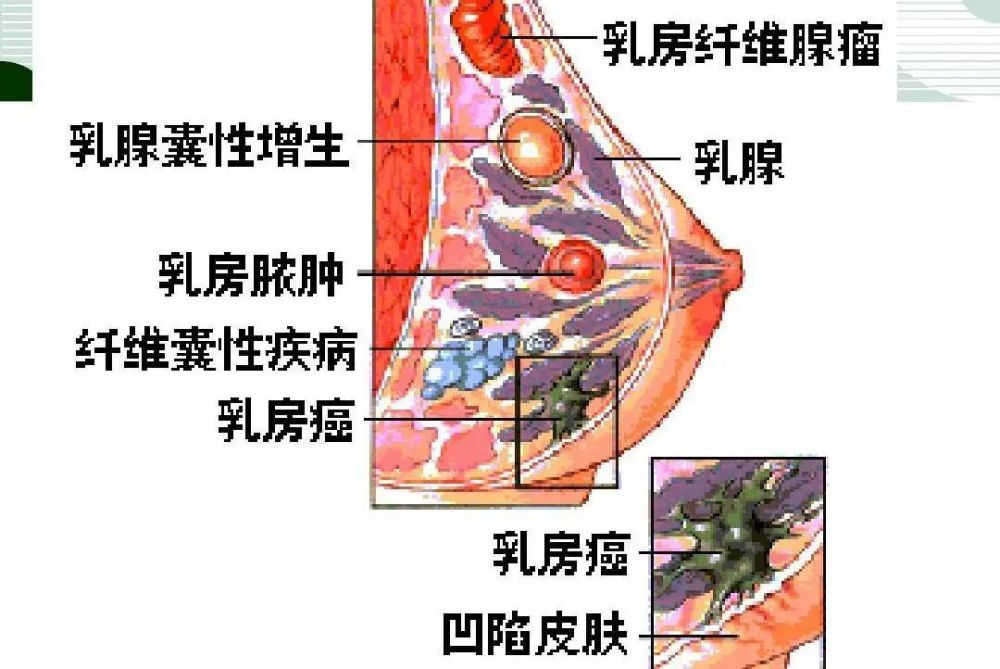 乳腺皮肤出现一个小凹陷,就像小酒窝,皮肤稍水肿如橘皮样改变等