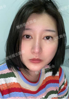 从"朝天鼻"到"箭头鼻"再到"小翘鼻,这两年我经历了啥?