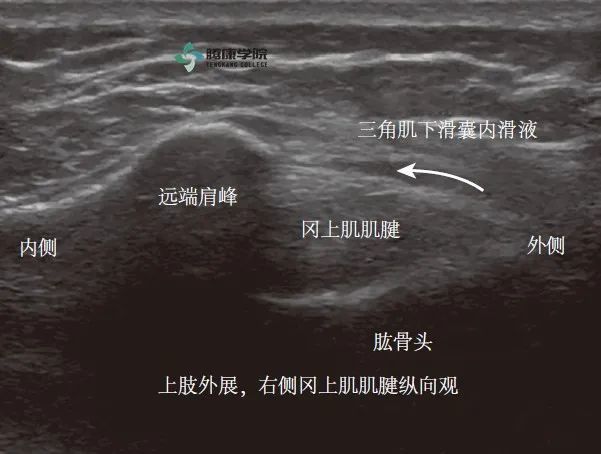 疼痛解剖学肱二头肌肌腱炎