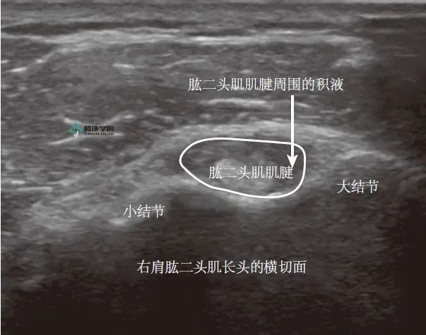 横切面超声图像显示肱二头肌肌腱炎.注意发炎的肌腱周围的液体信号