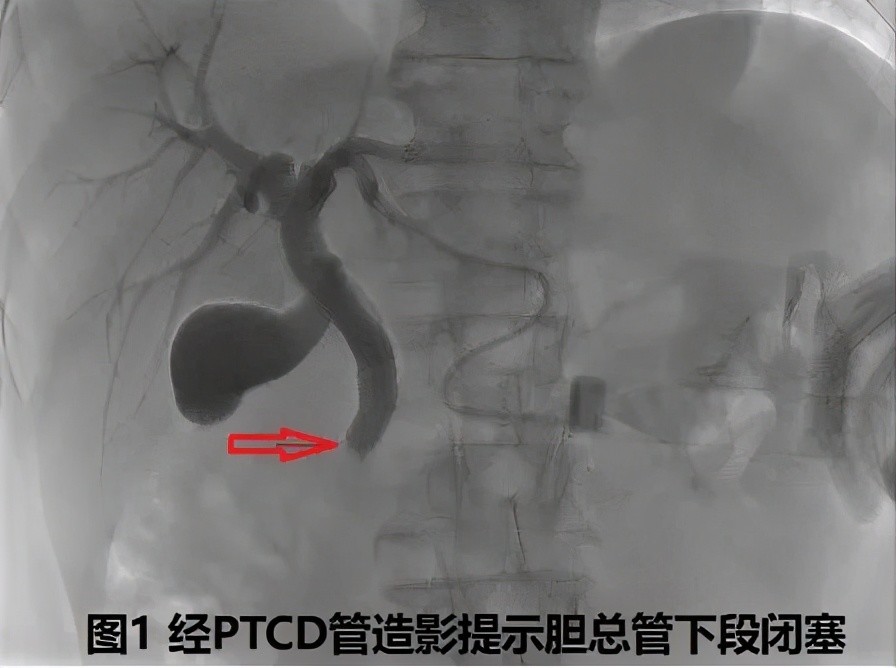 经ptcd导管造影提示胆总管下段闭塞