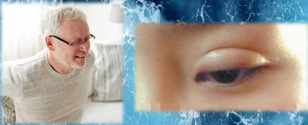 肾性水肿引起的眼皮水肿,与其他水肿相比比较特殊的是,肾性水肿往往