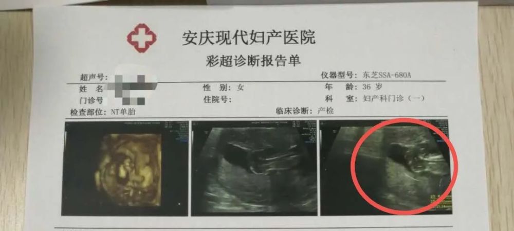二, 胎儿多囊肾 四维彩超下无所遁形