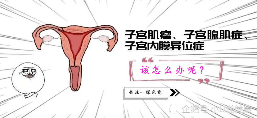 这4个原因,能诱发子宫腺肌症!