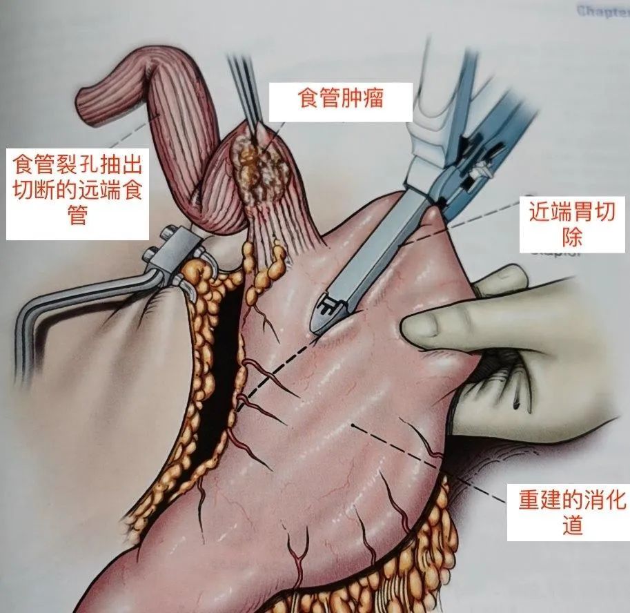 癌手术,切除癌变食管后,通常会把部分胃切除翻转上去,与食管切口吻合