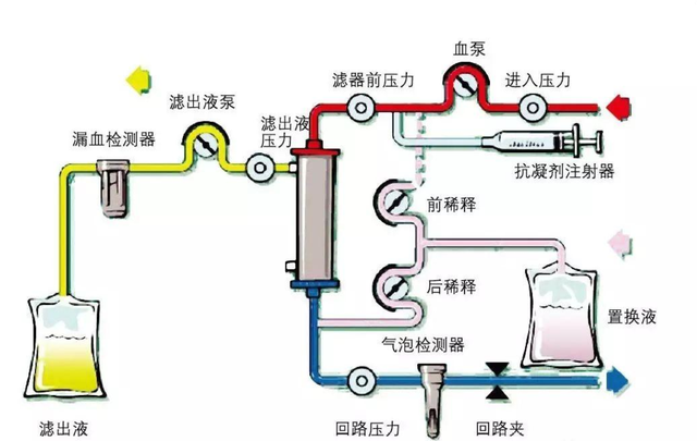 为什么人工肾能够延长寿命?目前发展到什么程度了?_腾讯新闻