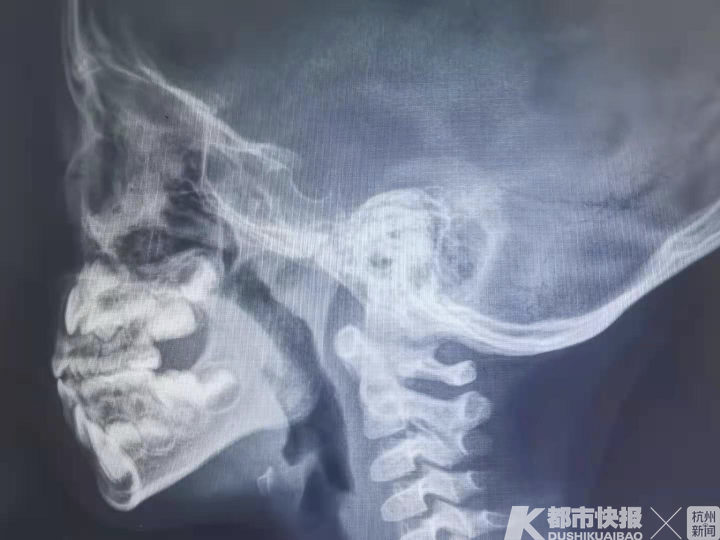 腺样体肥大,肥大的腺样体阻塞90%以上气道