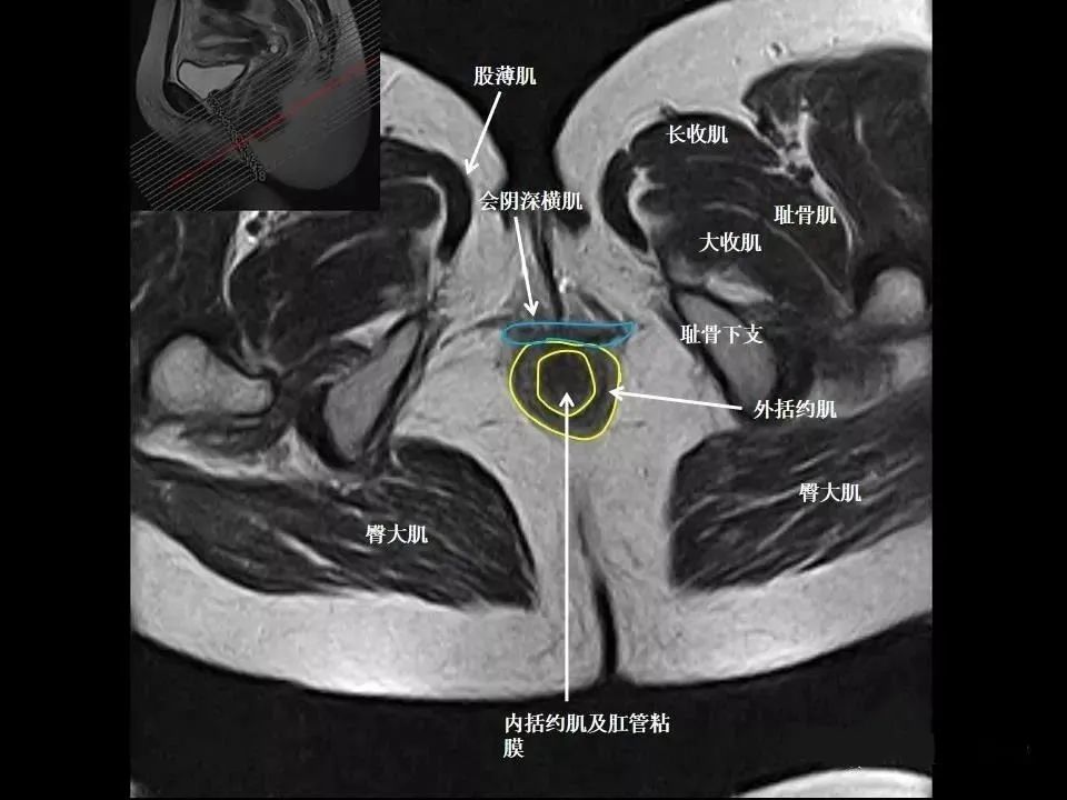 张8图带你熟悉盆底mri解剖