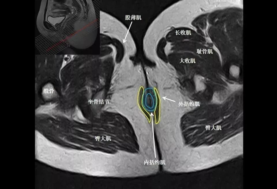 8张图带你熟悉盆底mri解剖