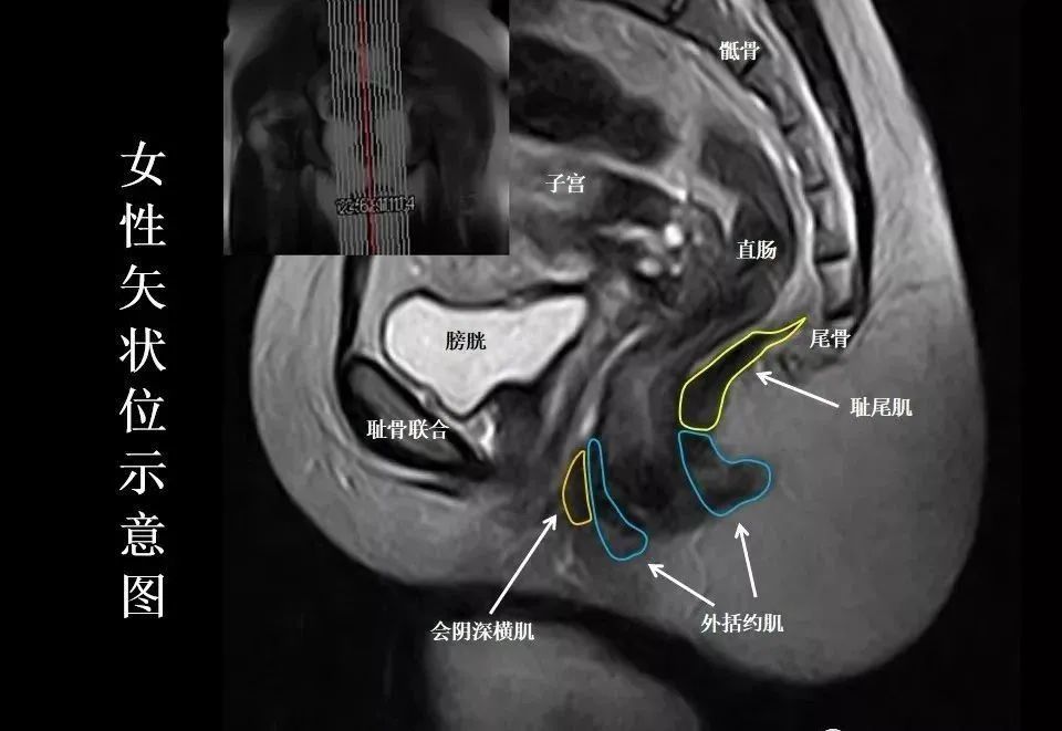 张8图带你熟悉盆底mri解剖