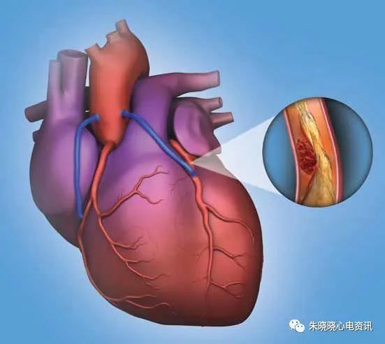 区域协同救治水平是决定急性心肌梗死救治效率的主要因素心肌梗死犯罪