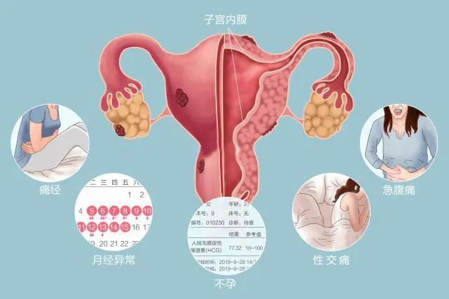 子宫内膜异位症与某些炎症如腹膜炎有关,表现为腹腔液中巨噬细胞,炎