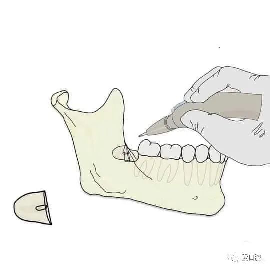 图示下颌阻生第三磨牙的拔除