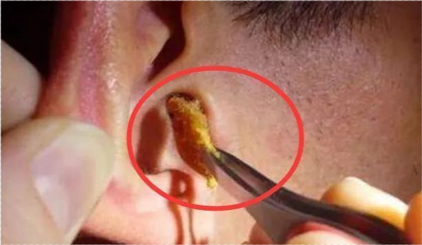 为啥有人耳屎又湿又油,有人却"干巴巴"的?3个原因,早自检!