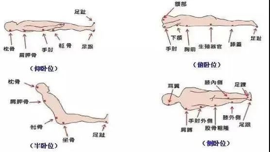 哪里容易发生压疮?