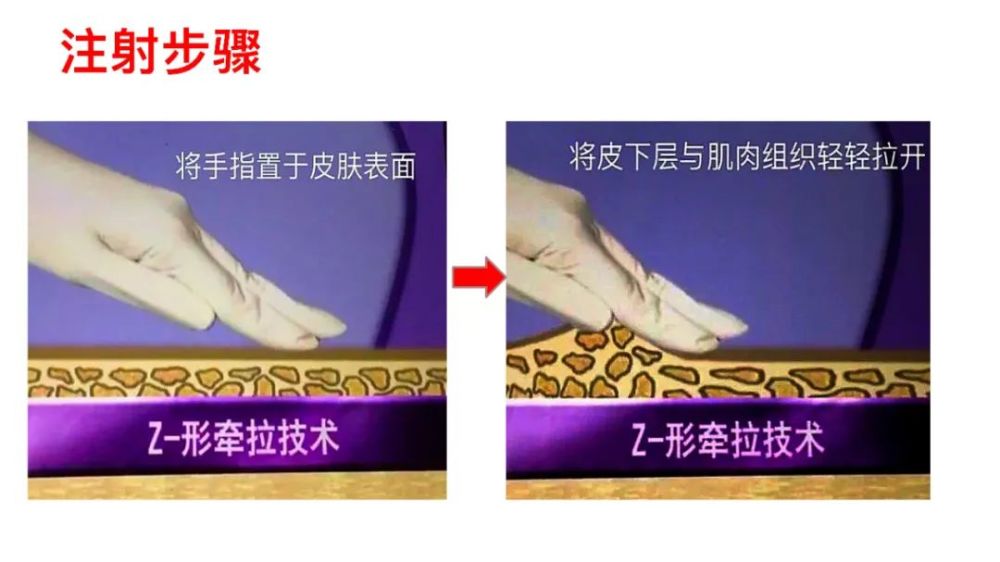 肌注硬结怎么办,z型注射法了解一下!
