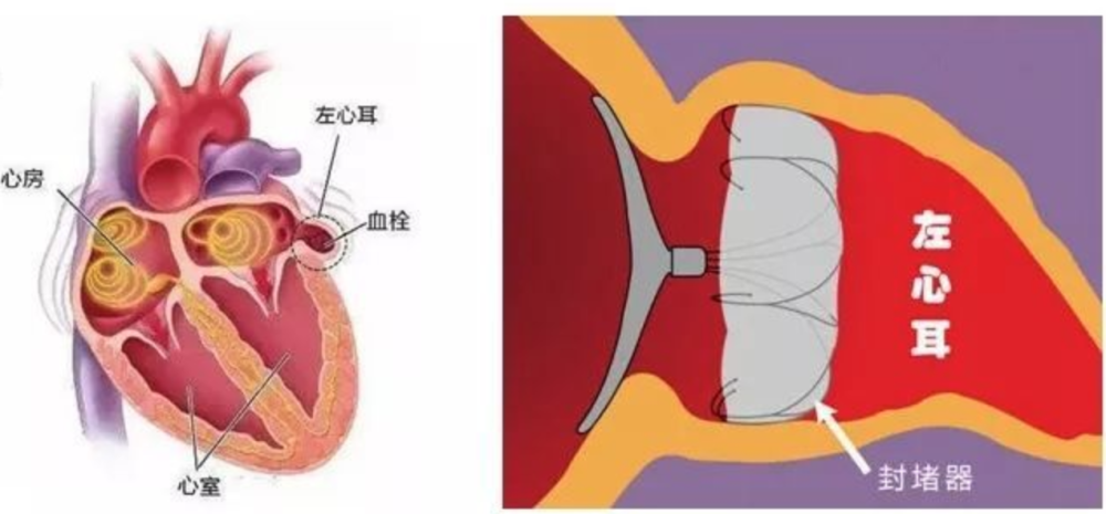 通过封堵左心耳来预防房颤时左心耳内血栓的形成,从而降低房颤患者因