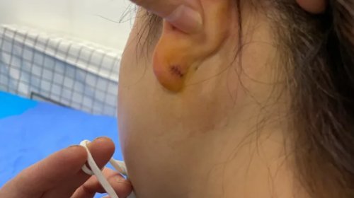 有些女士打完耳洞后,发现自己耳朵长了个"疙瘩",但其实这个"疙瘩"是