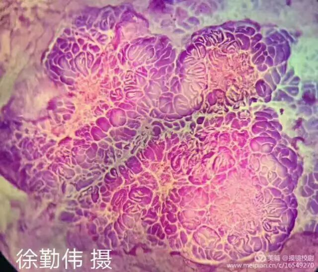 胃黏膜esd术后结晶紫染色 浓度为0.03%