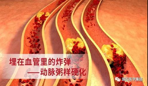 高血糖是怎么伤血管的?听专家怎么说