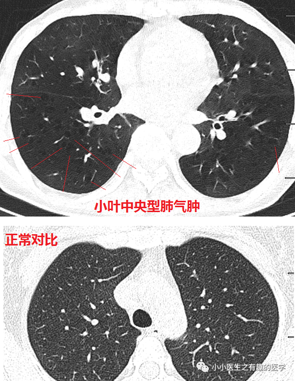 03慢慢的感觉一下!肺气肿在哪儿?一目了然!ct分辨率的重要性!