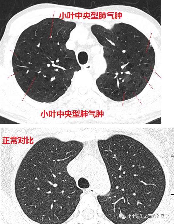 ct经典图谱:肺气肿ct典型图谱,一学就会