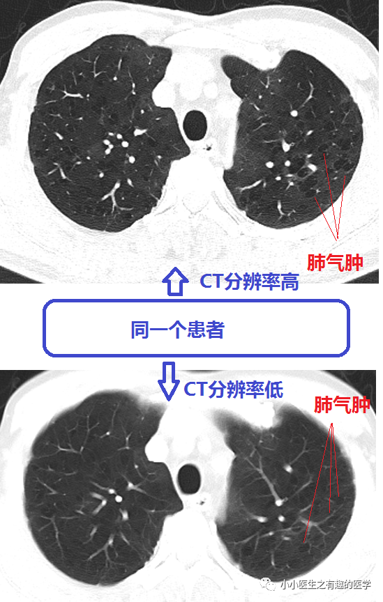 ct经典图谱肺气肿ct典型图谱一学就会