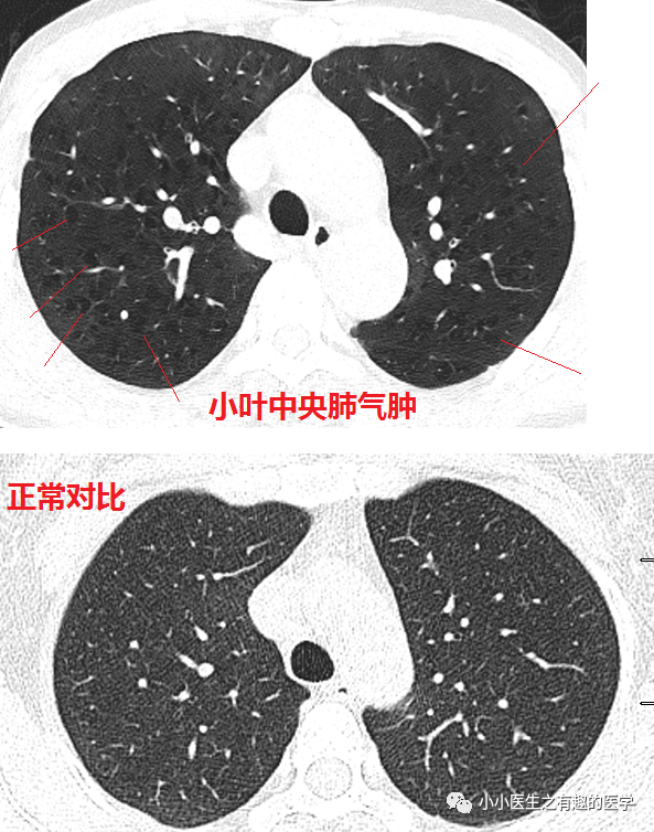 03慢慢的感觉一下!肺气肿在哪儿?一目了然!ct分辨率的重要性!