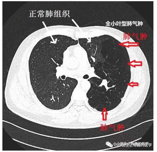 ct经典图谱:肺气肿ct典型图谱,一学就会