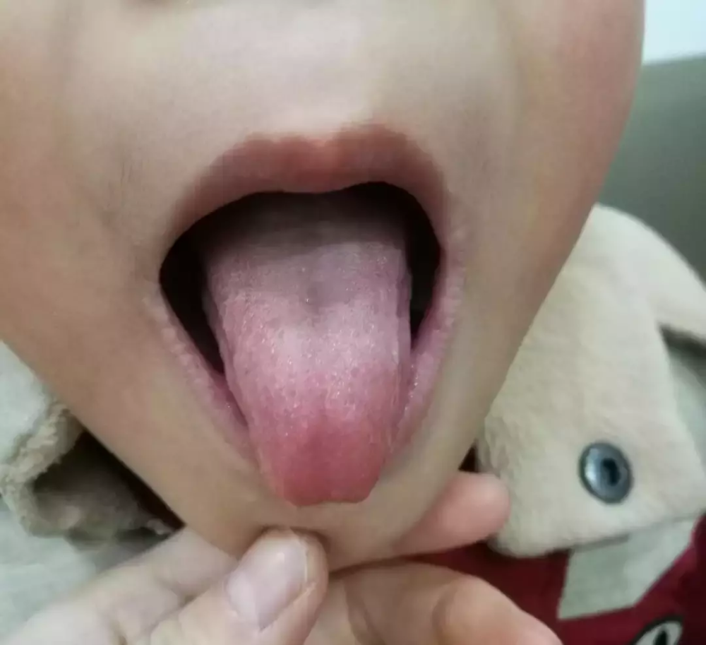 肝气郁结的孩子,舌头前段是红红的,鼓起来的
