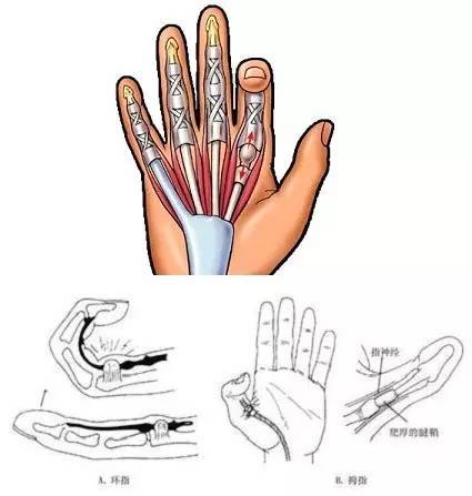 食指与中指的手掌面,清晨醒来时特别明显,患指表现为屈伸功能障碍