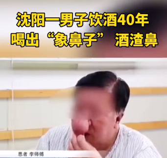 什么是酒渣鼻?真的是喝酒导致的