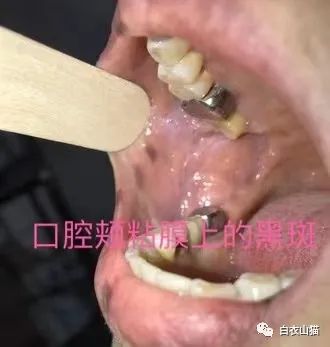 上面就是她嘴巴里面,口腔黏膜上的黑色斑块.