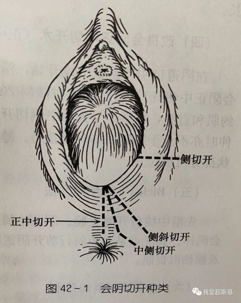 顺产生娃会阴侧切的时候,会切到阴蒂吗?