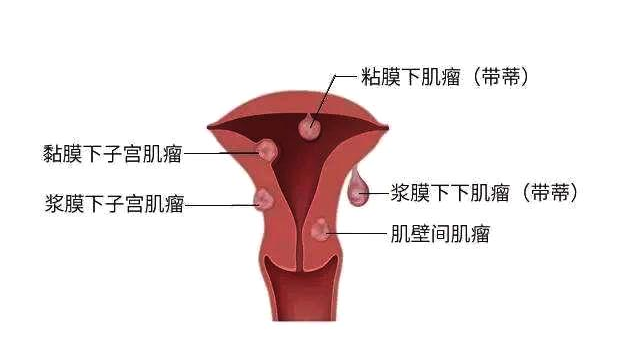 子宫肌瘤是癌症吗?要不要做手术?