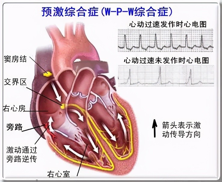 柳州市妇幼保健院成功为心脏预激综合征患儿行射频消融术手术