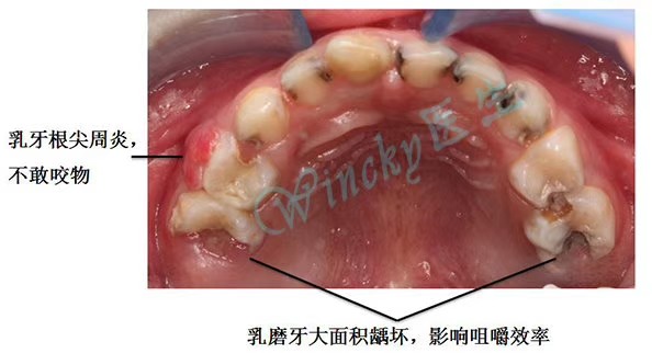 儿童乳牙龋坏不及时治疗的危害性