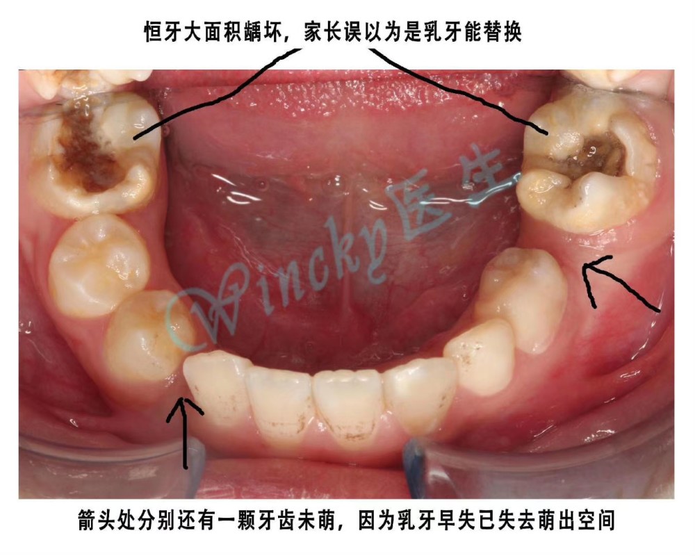 儿童乳牙龋坏不及时治疗的危害性