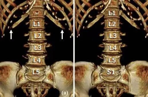 去掉胸骨的全脊柱片,显示出了腰肋(从上往下数第13肋) 内容来源|骨