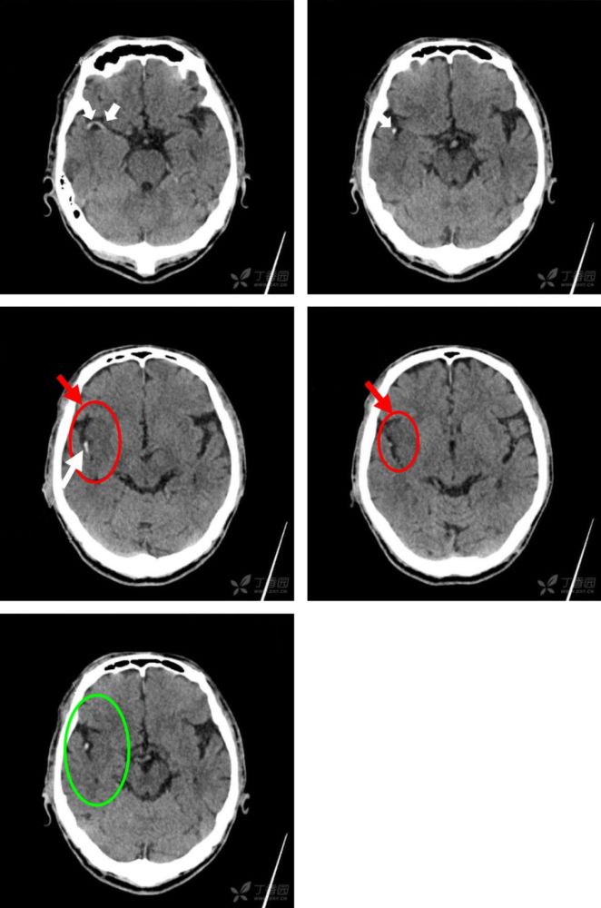 ct 平扫出现以下几种征象可提示脑梗死:脑动脉高密度征;岛带征;脑实质