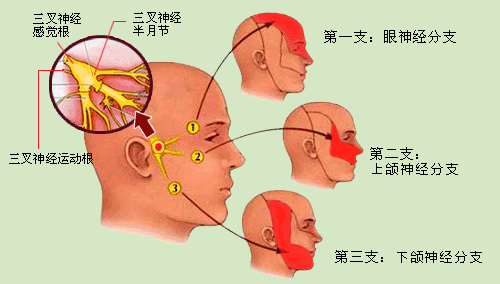 科普|"天下第一痛":三叉神经痛,别再当作牙痛治了!