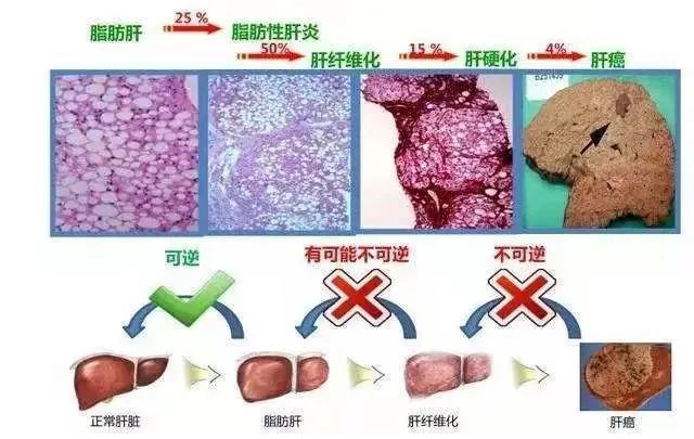 5个症状警惕酒精肝来袭