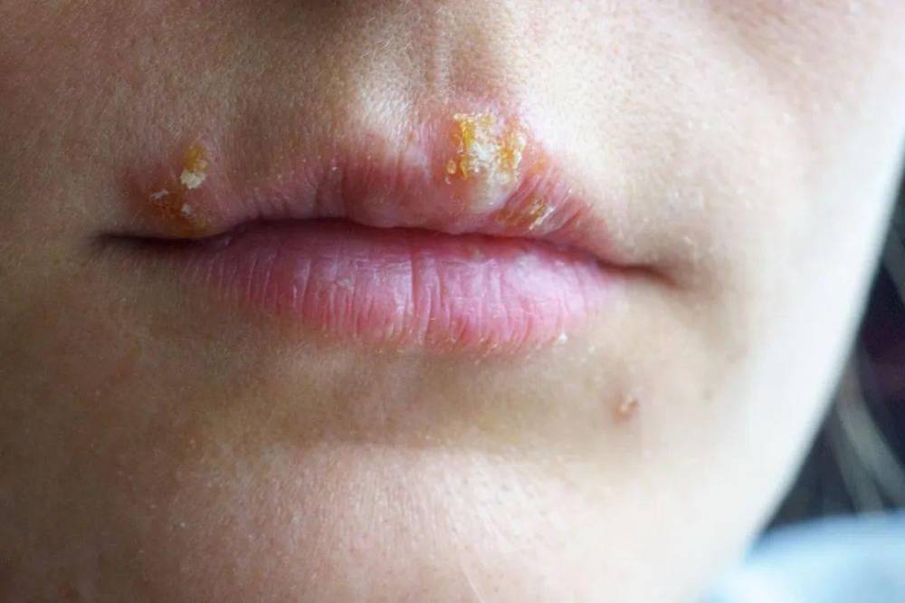 大家嘴巴附近长的这个泡或者疱疹,在医学上有个名字叫 「口唇疱疹」