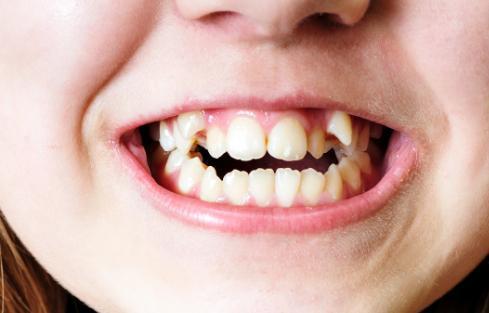 孩子换牙齿,新长的牙齿却是歪的,可能是家长这些没做好