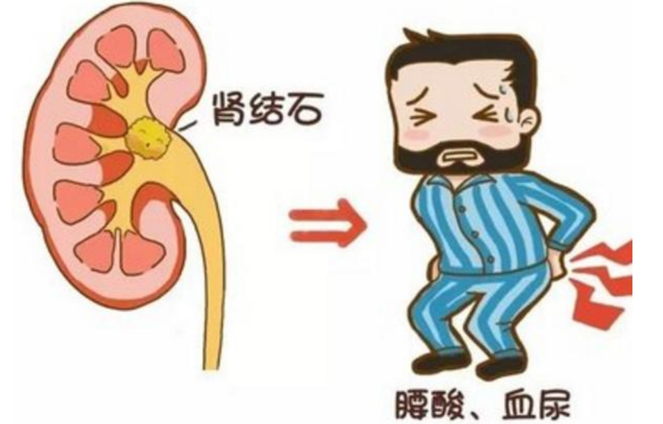 肾结石产生的3个主要原因,四种方法可缓解,平常养成几个好习惯