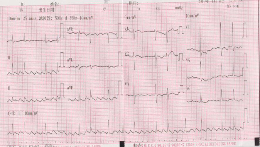 图1  房颤发作心电图【辅助检查】【入院查体】bp138/80mmhg,双肺呼吸