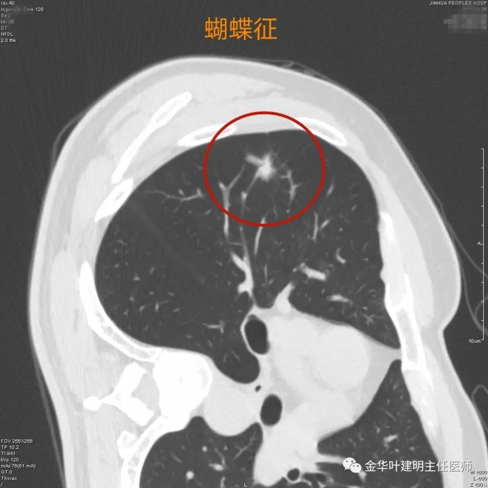 3.31):珍藏-肺结节常见的恶性影像特征